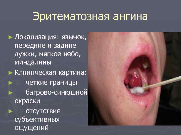   Эритематозная ангина ► Локализация:  язычок,  передние и задние  дужки,