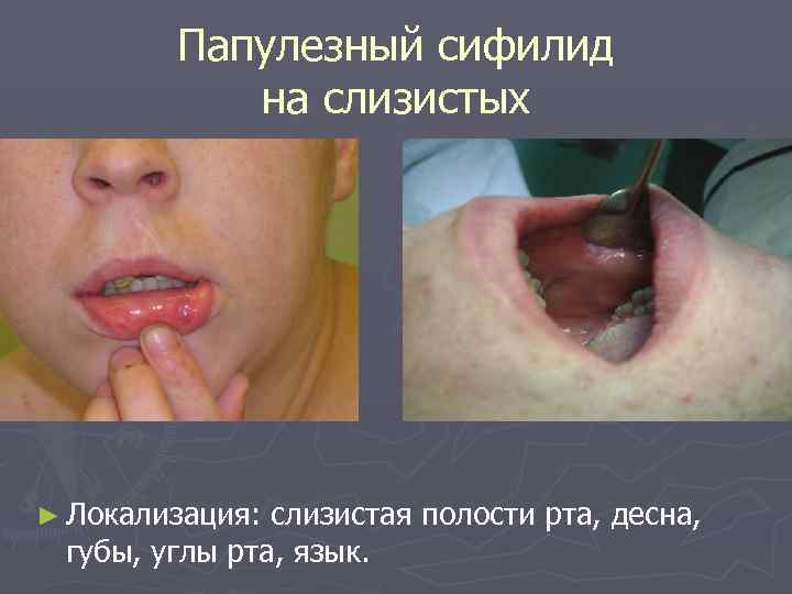   Папулезный сифилид  на слизистых ► Локализация: слизистая полости рта, десна, 