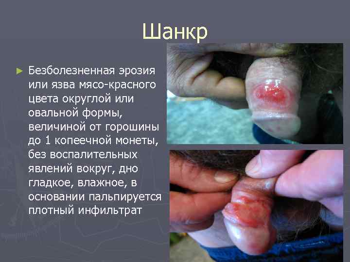      Шанкр ►  Безболезненная эрозия или язва мясо-красного цвета