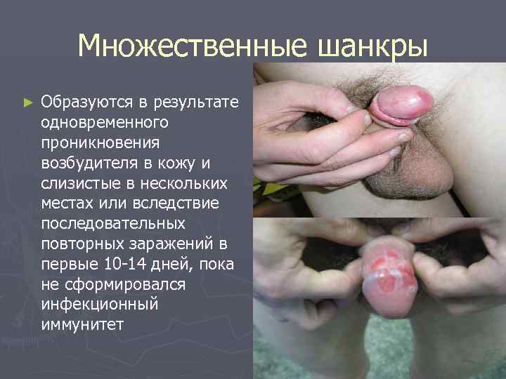   Множественные шанкры ►  Образуются в результате одновременного проникновения возбудителя в кожу