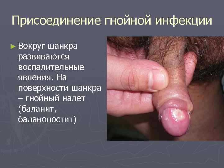 Присоединение гнойной инфекции ► Вокругшанкра развиваются воспалительные явления. На поверхности шанкра – гнойный налет