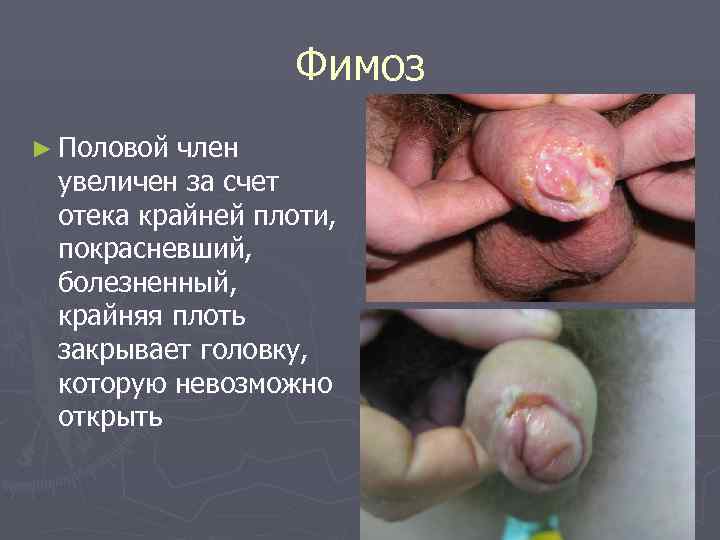    Фимоз ► Половой член увеличен за счет отека крайней плоти, 