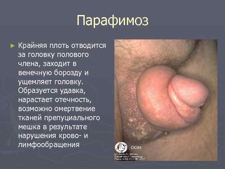     Парафимоз ►  Крайняя плоть отводится за головку полового члена,
