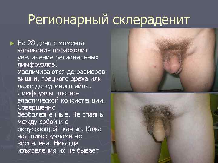   Регионарный склераденит ►  На 28 день с момента заражения происходит увеличение