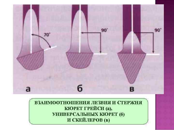 ВЗАИМООТНОШЕНИЯ ЛЕЗВИЯ И СТЕРЖНЯ   КЮРЕТ ГРЕЙСИ (а),  УНИВЕРСАЛЬНЫХ КЮРЕТ (б) 