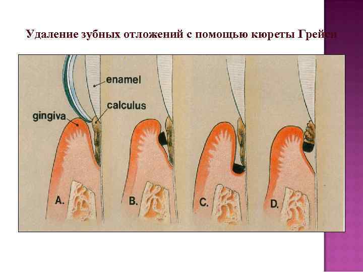 Зубные отложения презентация