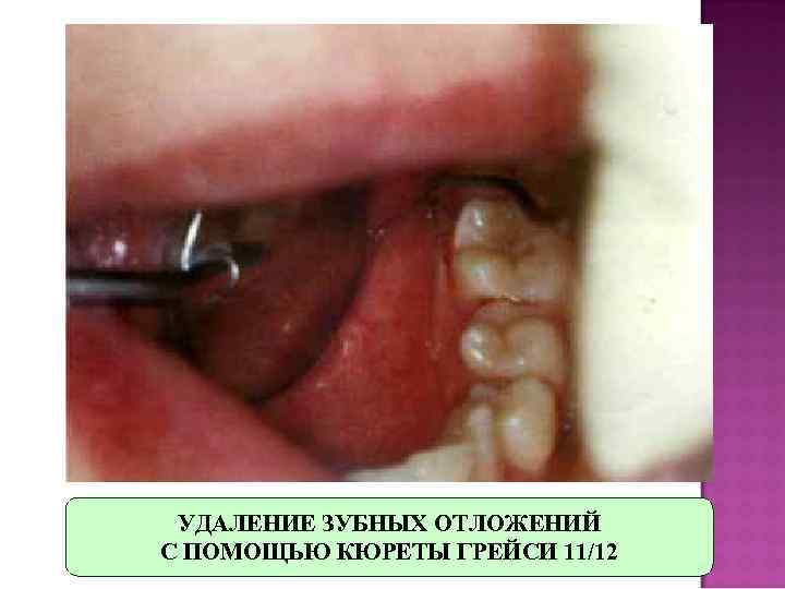 Зубные отложения презентация