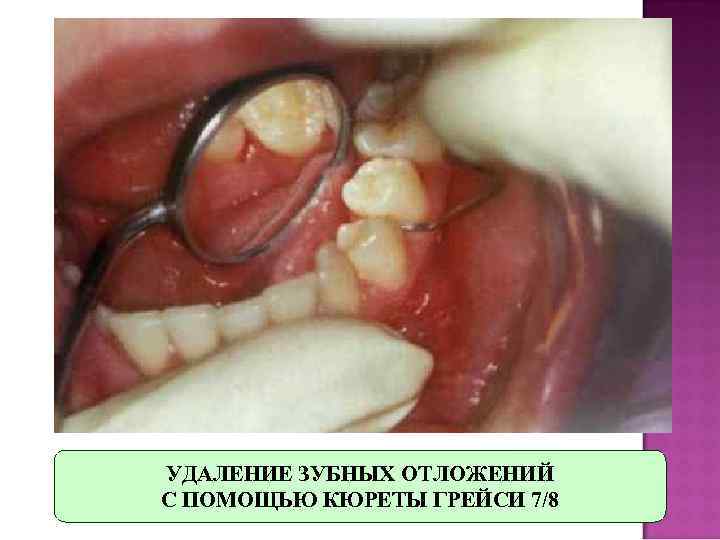 УДАЛЕНИЕ ЗУБНЫХ ОТЛОЖЕНИЙ С ПОМОЩЬЮ КЮРЕТЫ ГРЕЙСИ 7/8 