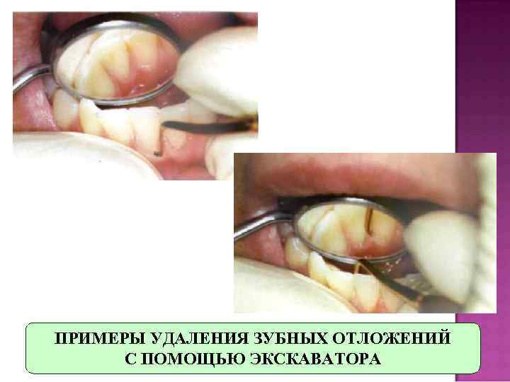 ПРИМЕРЫ УДАЛЕНИЯ ЗУБНЫХ ОТЛОЖЕНИЙ  С ПОМОЩЬЮ ЭКСКАВАТОРА 