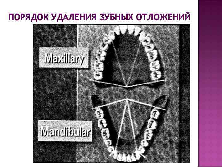 ПОРЯДОК УДАЛЕНИЯ ЗУБНЫХ ОТЛОЖЕНИЙ 