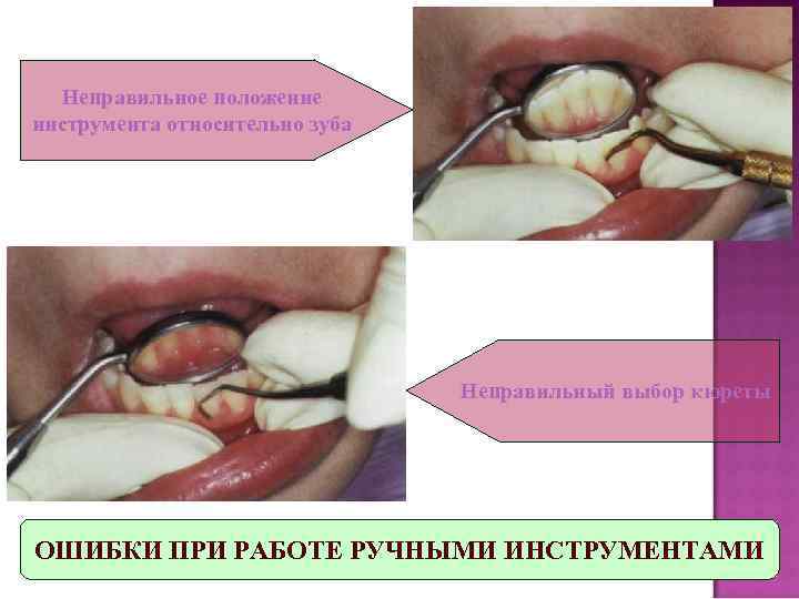 Зубные отложения презентация