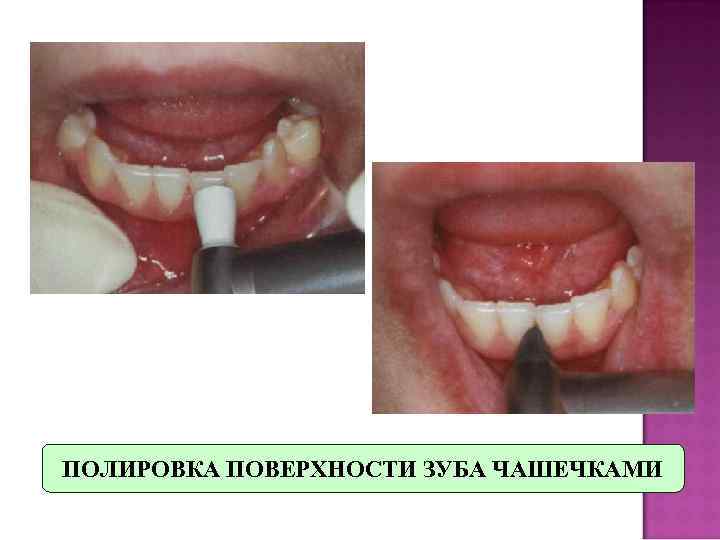 ПОЛИРОВКА ПОВЕРХНОСТИ ЗУБА ЧАШЕЧКАМИ 