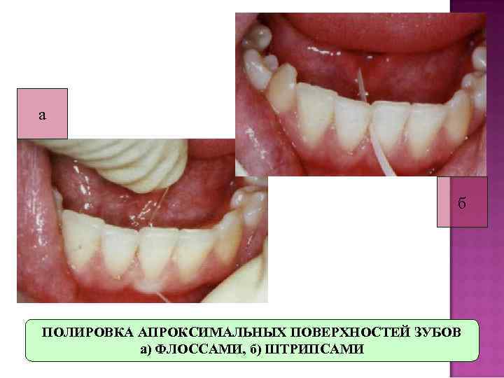 а    б ПОЛИРОВКА АПРОКСИМАЛЬНЫХ ПОВЕРХНОСТЕЙ ЗУБОВ  а) ФЛОССАМИ, б) ШТРИПСАМИ