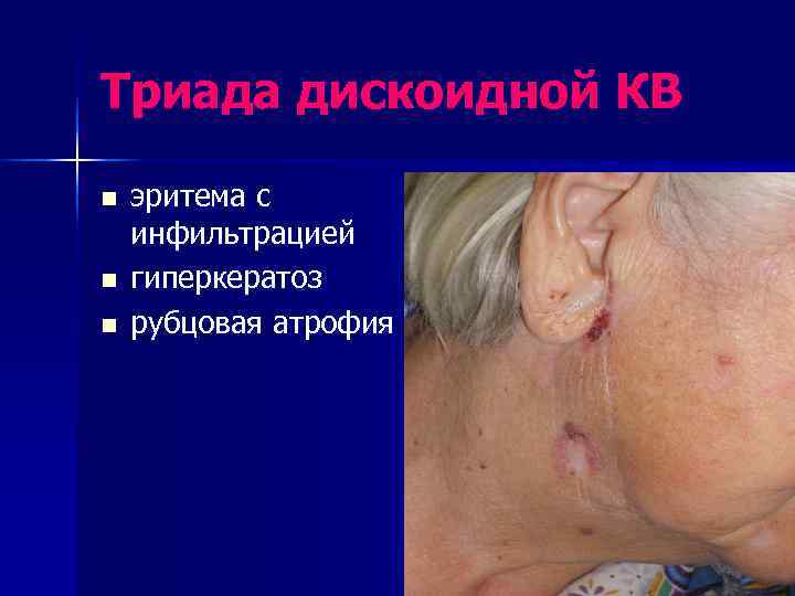 Триада дискоидной КВ n  эритема с инфильтрацией n  гиперкератоз n  рубцовая