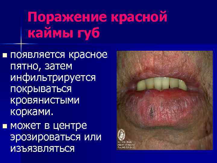   Поражение красной каймы губ n появляется красное  пятно, затем  инфильтрируется