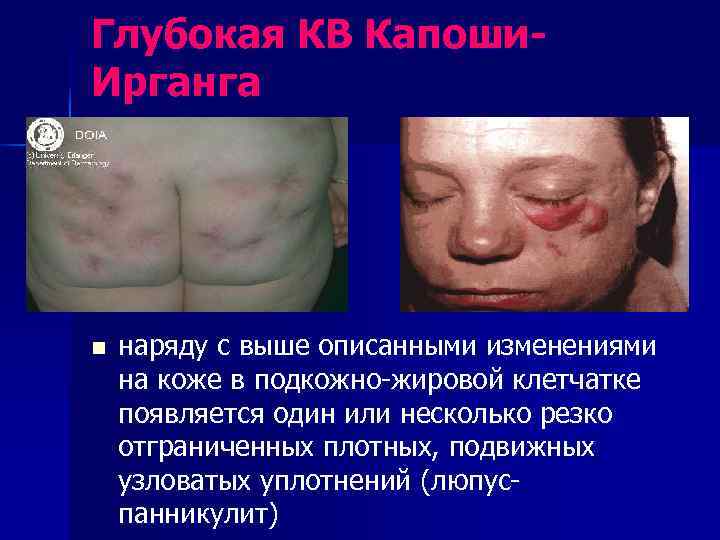 Глубокая КВ Капоши- Ирганга n  наряду с выше описанными изменениями на коже в