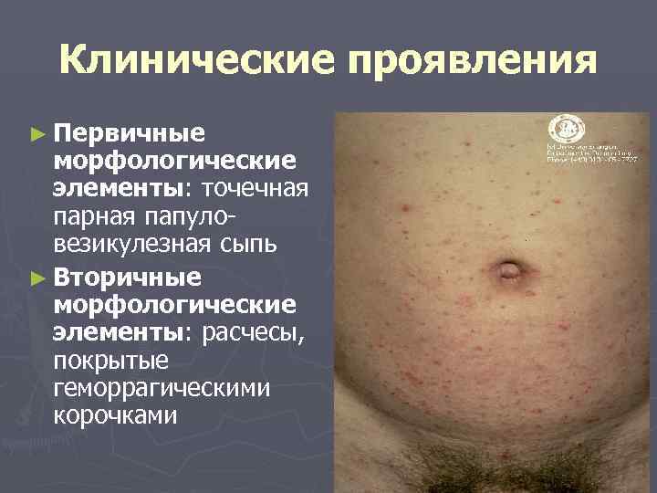  Клинические проявления ► Первичные  морфологические  элементы: точечная  парная папуло- 