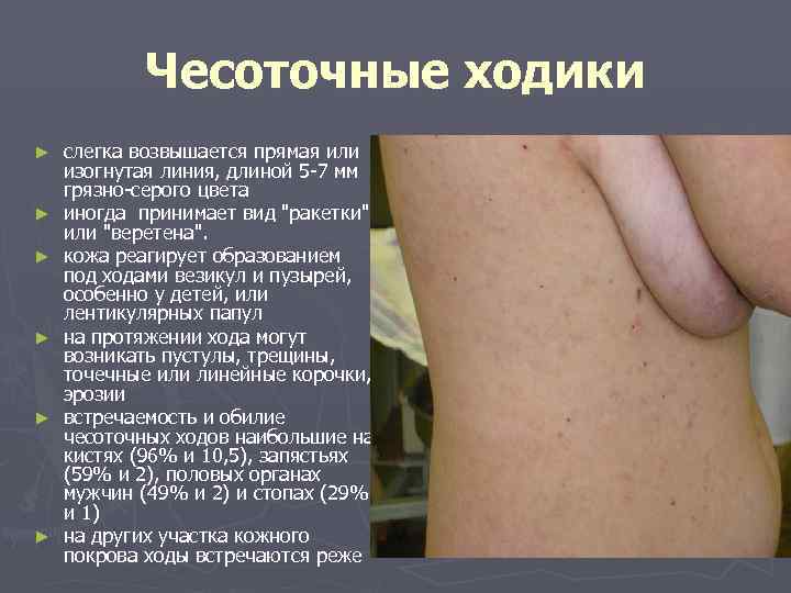   Чесоточные ходики ►  слегка возвышается прямая или изогнутая линия, длиной 5