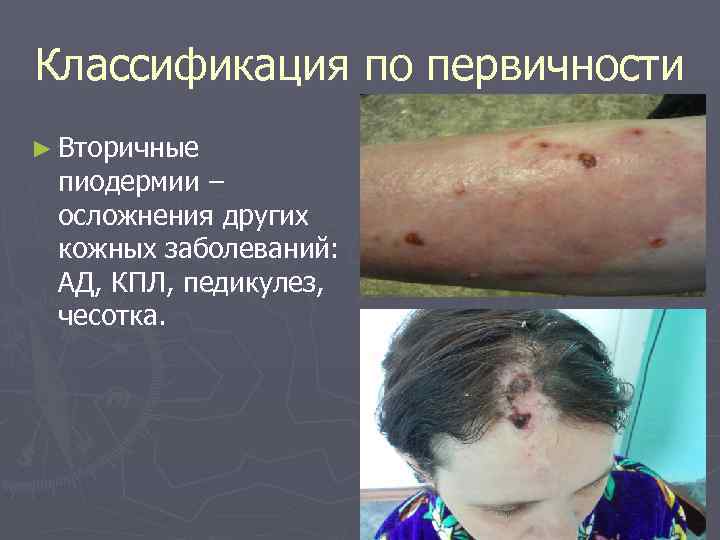 Классификация по первичности ► Вторичные пиодермии – осложнения других кожных заболеваний:  АД, КПЛ,