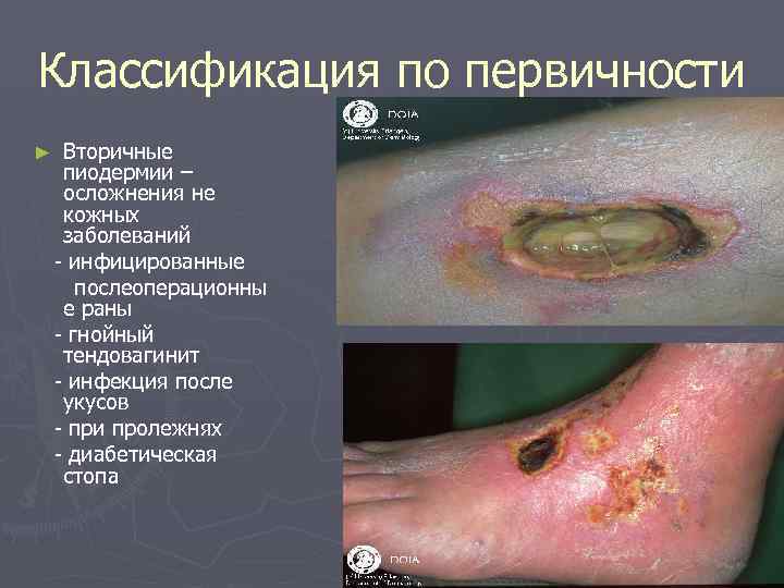 Классификация по первичности ►  Вторичные пиодермии – осложнения не кожных заболеваний - инфицированные