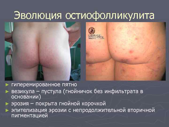   Эволюция остиофолликулита ► гиперемированное пятно ► везикула – пустула (гнойничок без инфильтрата