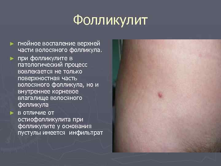     Фолликулит ► гнойное воспаление верхней  части волосяного фолликула. ►