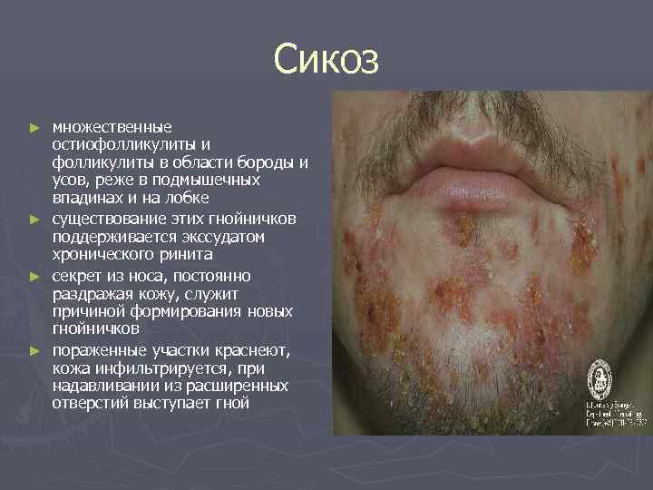      Сикоз ►  множественные остиофолликулиты и фолликулиты в области