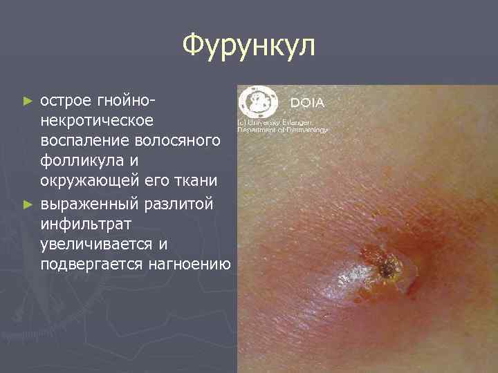    Фурункул ► острое гнойно-  некротическое  воспаление волосяного  фолликула