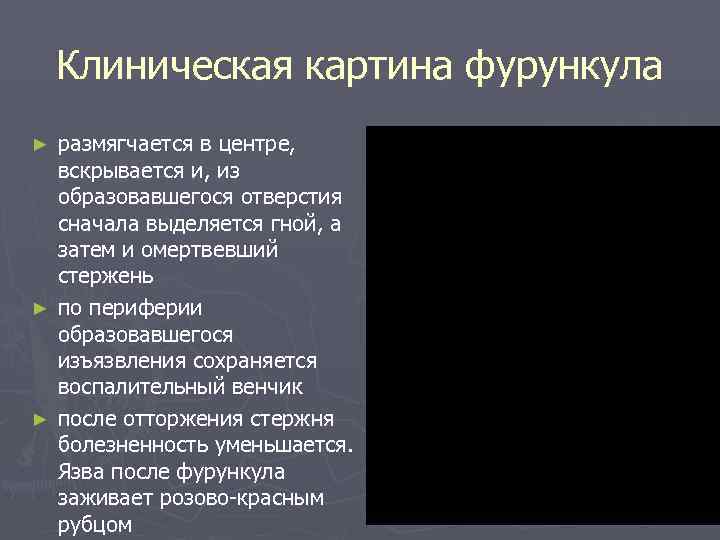   Клиническая картина фурункула ► размягчается в центре,  вскрывается и, из 