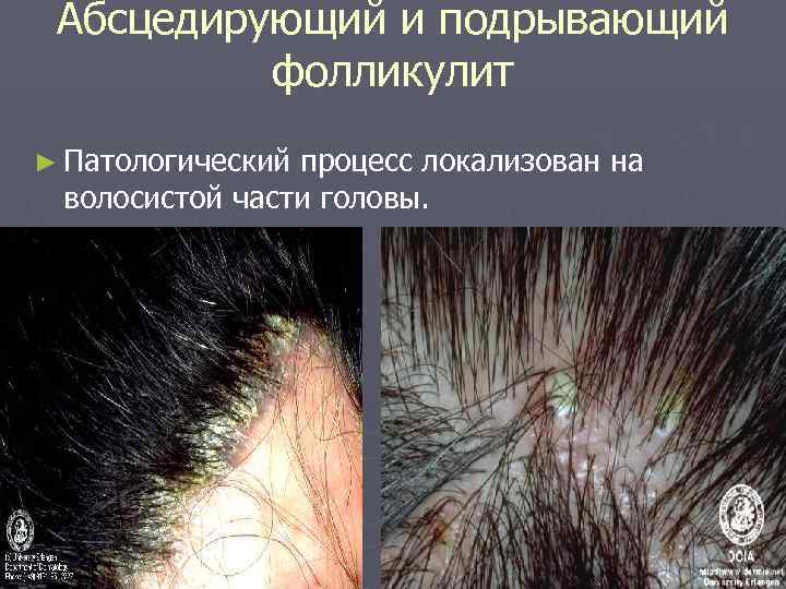  Абсцедирующий и подрывающий  фолликулит ► Патологическийпроцесс локализован на волосистой части головы. 
