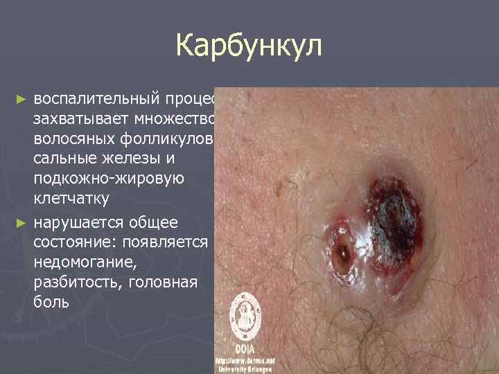    Карбункул ► воспалительный процесс,  захватывает множество  волосяных фолликулов, 