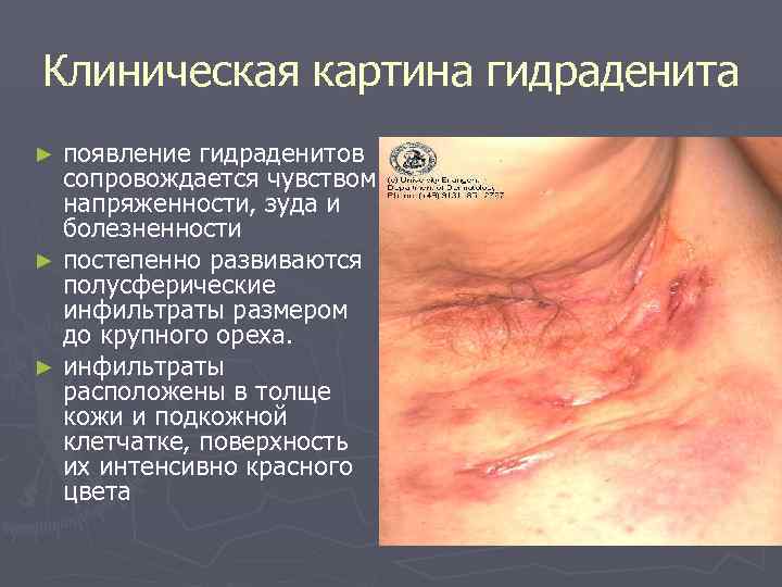 Клиническая картина гидраденита ► появление гидраденитов  сопровождается чувством  напряженности, зуда и 