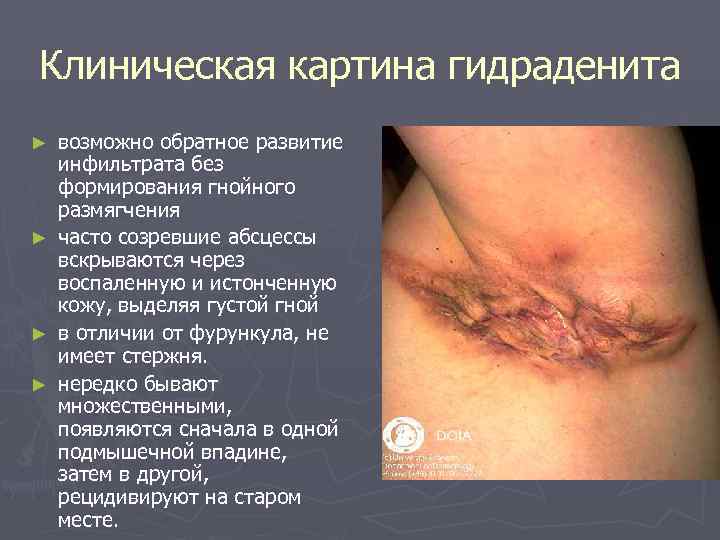 Клиническая картина гидраденита ► возможно обратное развитие  инфильтрата без  формирования гнойного 
