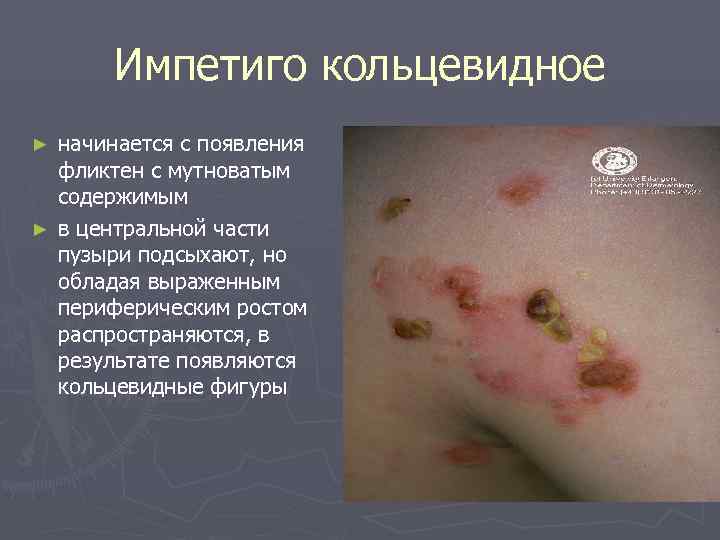   Импетиго кольцевидное ► начинается с появления  фликтен с мутноватым  содержимым