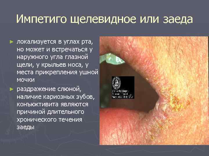   Импетиго щелевидное или заеда ► локализуется в углах рта,  но может