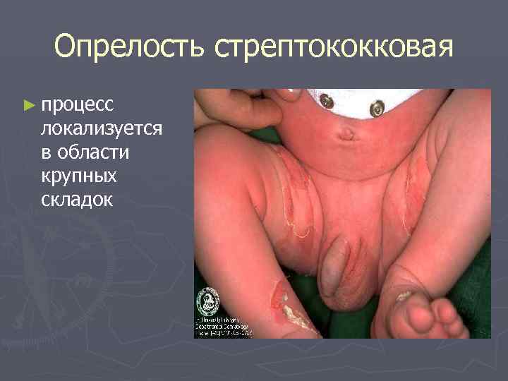   Опрелость стрептококковая ► процесс локализуется в области крупных складок 