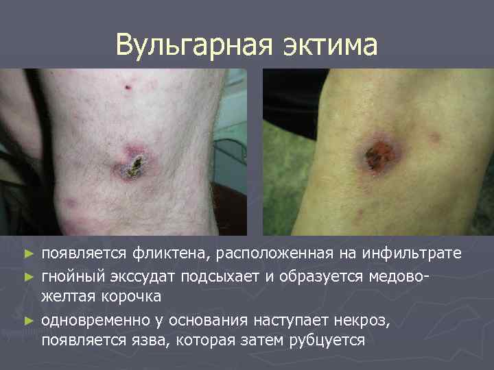    Вульгарная эктима ► появляется фликтена, расположенная на инфильтрате ► гнойный экссудат