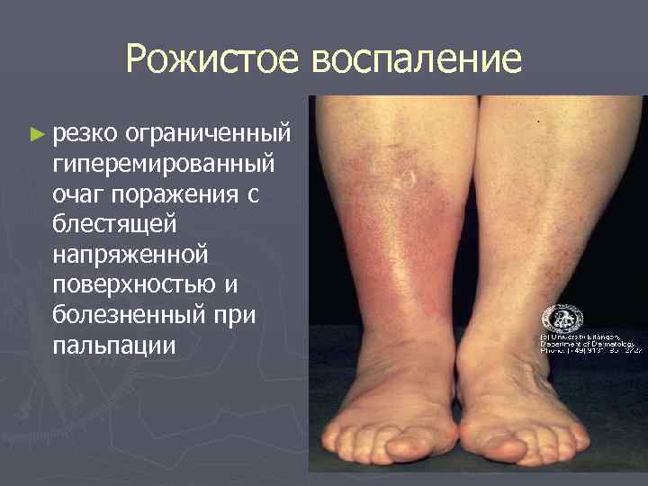    Рожистое воспаление ► резкоограниченный гиперемированный очаг поражения с блестящей напряженной поверхностью