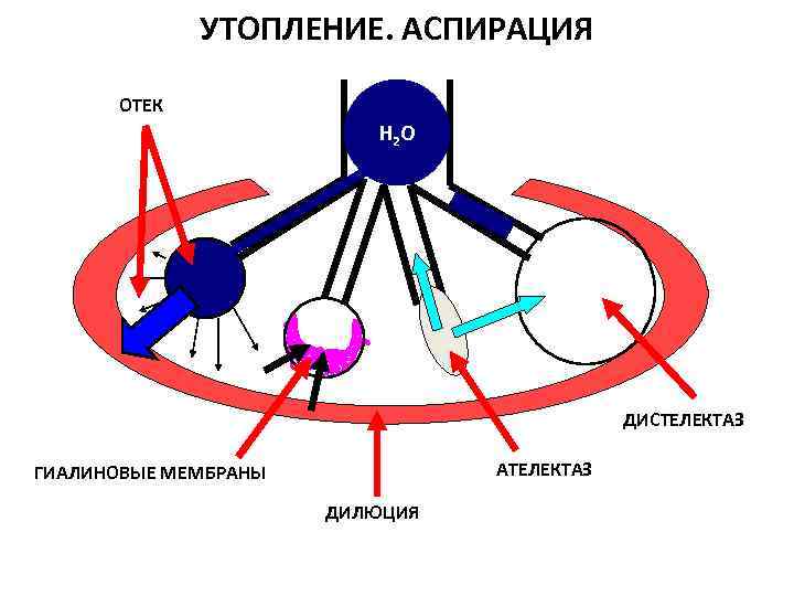    УТОПЛЕНИЕ. АСПИРАЦИЯ  ОТЕК     Н 2 О