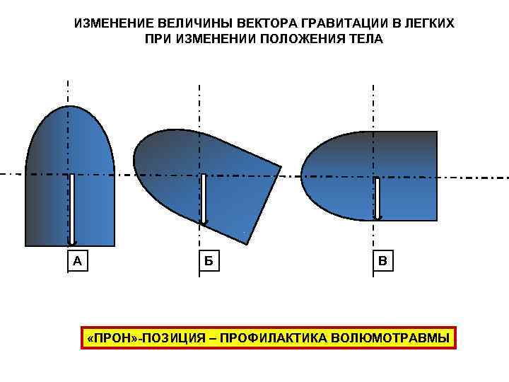 ИЗМЕНЕНИЕ ВЕЛИЧИНЫ ВЕКТОРА ГРАВИТАЦИИ В ЛЕГКИХ   ПРИ ИЗМЕНЕНИИ ПОЛОЖЕНИЯ ТЕЛА А 