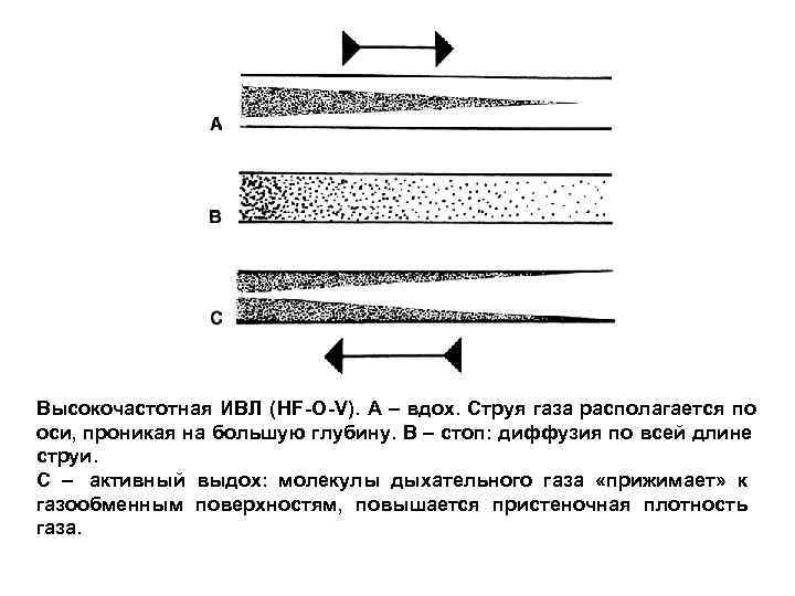 Высокочастотная ИВЛ (HF-О-V). А – вдох. Струя газа располагается по оси, проникая на большую