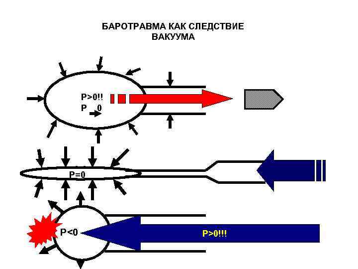    БАРОТРАВМА КАК СЛЕДСТВИЕ    ВАКУУМА  P>0!!  P