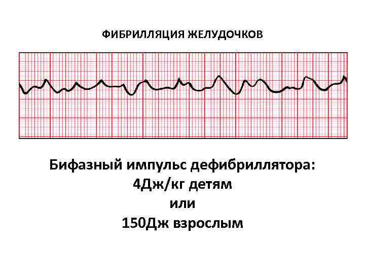 ФИБРИЛЛЯЦИЯ ЖЕЛУДОЧКОВ Бифазный импульс дефибриллятора: 4 Дж/кг детям или ФИБРИЛЛЯЦИЯ ЖЕЛУДОЧКОВ Бифазный импульс дефибриллятора: 4 Дж/кг детям или