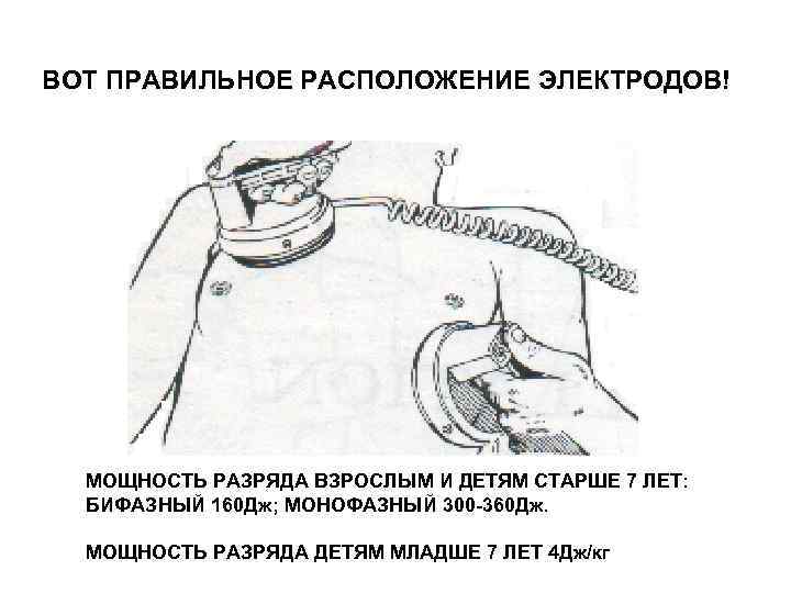 ВОТ ПРАВИЛЬНОЕ РАСПОЛОЖЕНИЕ ЭЛЕКТРОДОВ! МОЩНОСТЬ РАЗРЯДА ВЗРОСЛЫМ И ДЕТЯМ СТАРШЕ 7 ЛЕТ: ВОТ ПРАВИЛЬНОЕ РАСПОЛОЖЕНИЕ ЭЛЕКТРОДОВ! МОЩНОСТЬ РАЗРЯДА ВЗРОСЛЫМ И ДЕТЯМ СТАРШЕ 7 ЛЕТ: