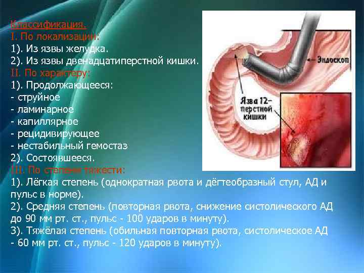 Классификация. I. По локализации: 1). Из язвы желудка. 2). Из язвы двенадцатиперстной кишки. II.