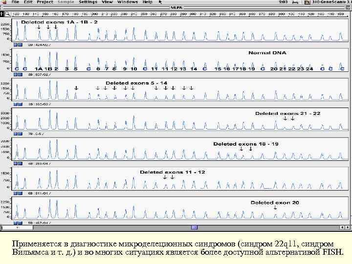Применяется в диагностике микроделеционных синдромов (синдром 22 q 11, синдром Вильямса и т. д.