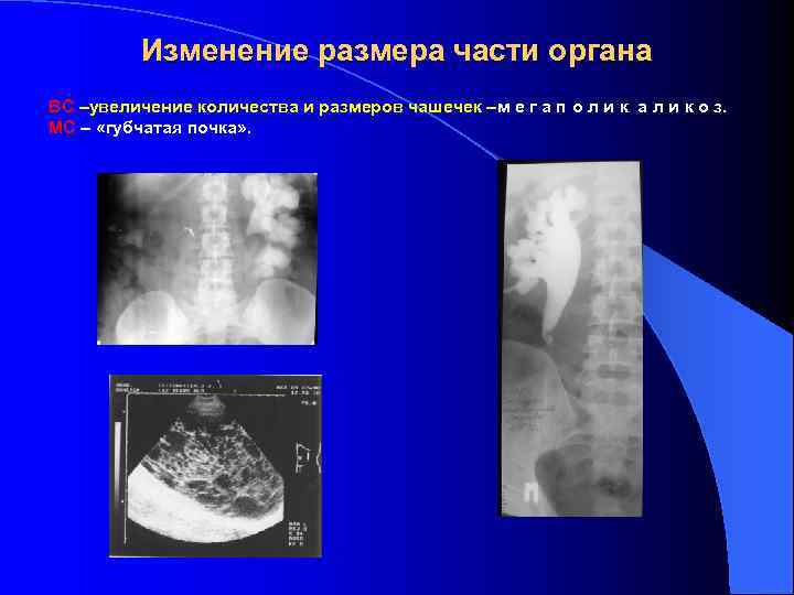    Изменение размера части органа ВС –увеличение количества и размеров чашечек –м