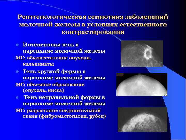 Рентгенологическая семиотика заболеваний молочной железы в условиях естественного   контрастирования l  Интенсивная