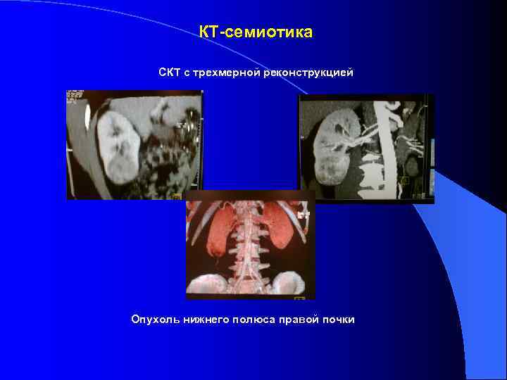    КТ-семиотика СКТ с трехмерной реконструкцией Опухоль нижнего полюса правой почки 