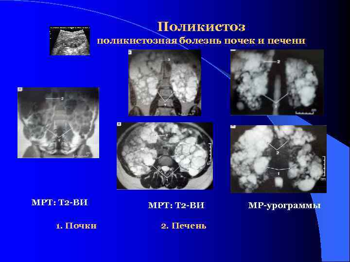 Лучевая диагностика мочевыделительной системы презентация